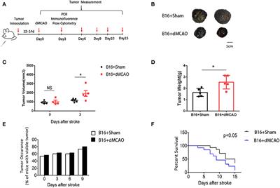 Stroke Exacerbates Cancer Progression by Upregulating LCN2 in PMN-MDSC